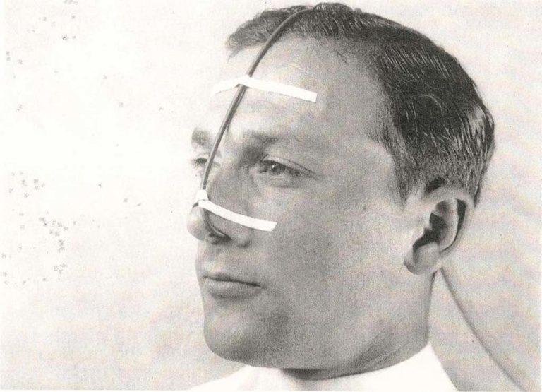 1920s Rubber Oxygen Catheter