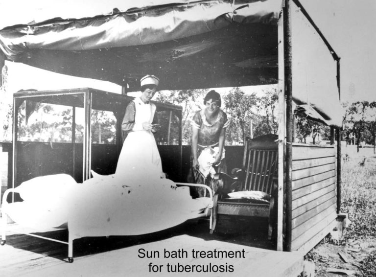 Sun Bath for TB